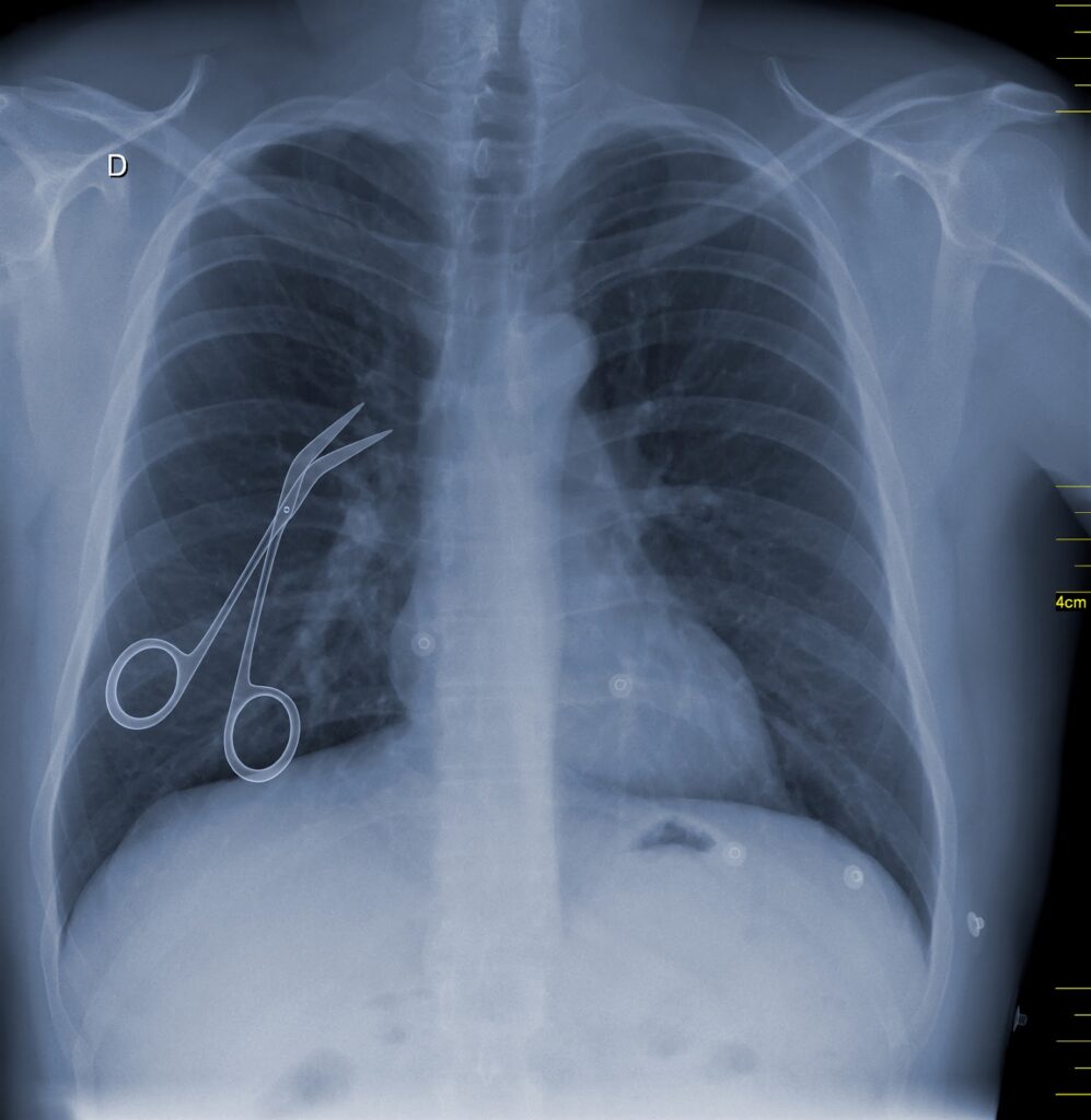 Conceptual imaging of scissors left inside a person's chest after surgery